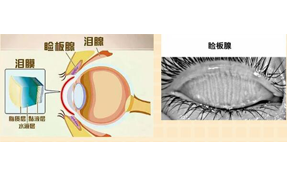 運用強(qiáng)脈沖光治療瞼板腺功能障礙相關(guān)干眼癥